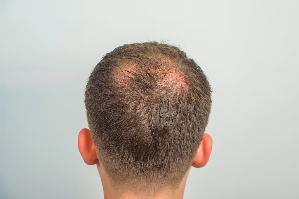 Beyond the Brush: How Hair Loss Affects Men and Ways to Fight Back
